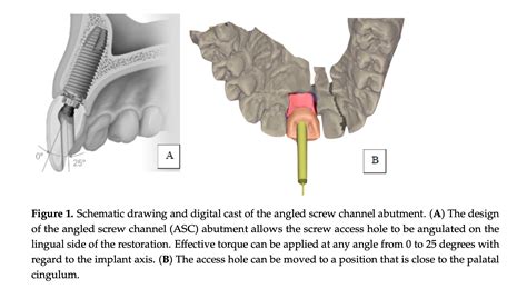 angled screw channel abutments